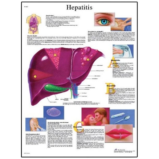 Leverbetndelse/hepatitis. Anatomisk plakat.