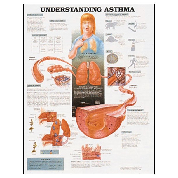 Astma. Anatomisk plakat 50x67 cm. Lamineret med lister.