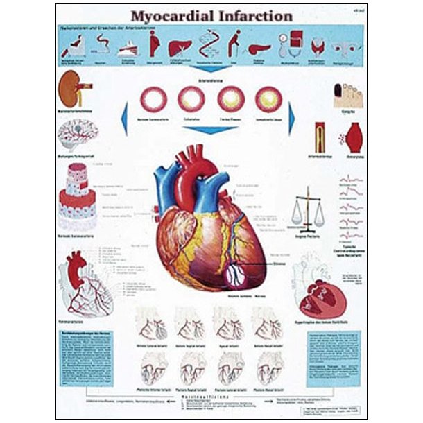 Blodprop i hjertet. Anatomisk plakat 50x67 cm.