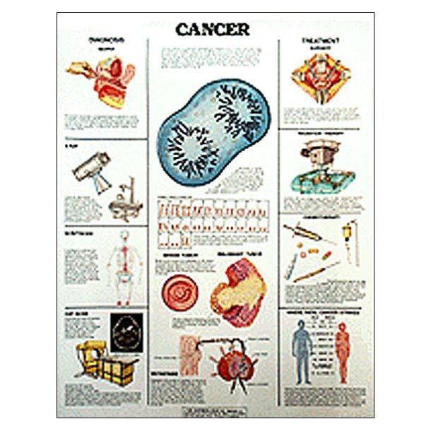 Cancer II. Anatomisk plakat 50x67 cm. Lamineret med lister.
