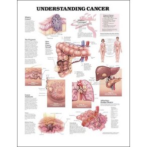 cancer I. Anatomisk plakat 50x67 cm. Lamineret med lister.