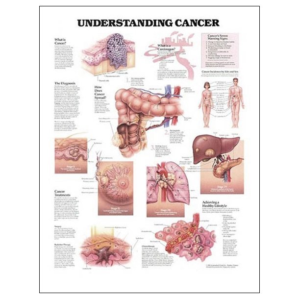 cancer I. Anatomisk plakat 50x67 cm. Lamineret med lister.