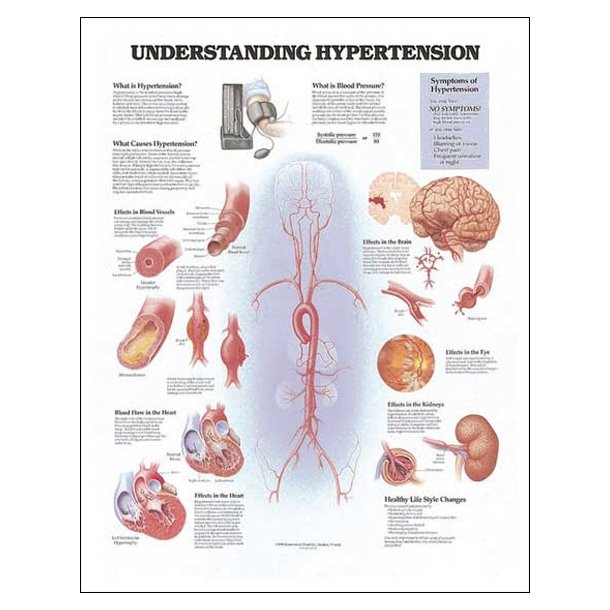 Forhjet blodtryk. Anatomisk plakat 50x67 cm. Lamineret med lister.