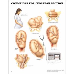 Kejsersnit. Anatomisk plakat 50x67 cm. Lamineret med lister.