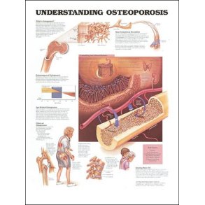 Osteoporose. 50x67 cm. Lamineret med lister.