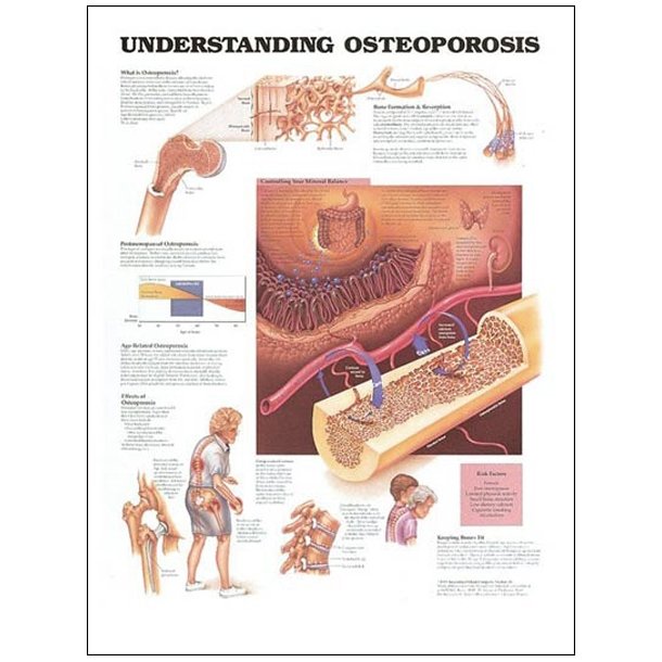 Osteoporose. 50x67 cm. Lamineret med lister.