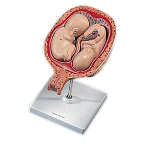 Livmoder med tvillingegraviditet i 5. m�ned