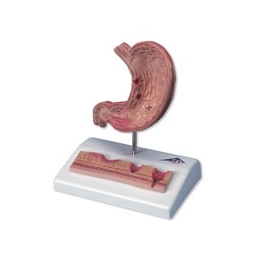 Maves�k med maves�r (ulcus ventriculi) og mavekatar (gastritis)