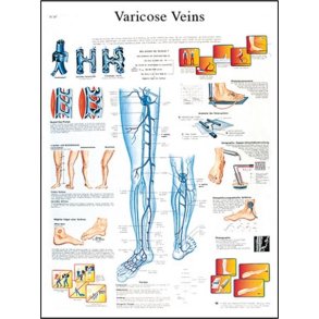 reknuder - varicer. Anatomisk plakat.