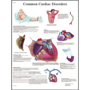 Almindelige hjertesygdomme. Anatomisk plakat 50x67 cm