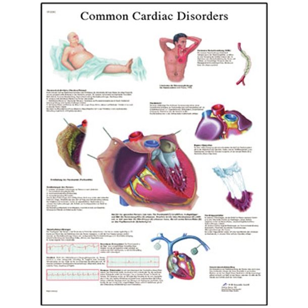 Almindelige hjertesygdomme. Anatomisk plakat 50x67 cm