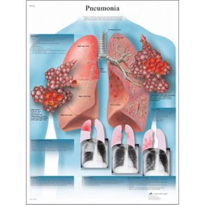 Lungebetndelse - pneumoni. Anatomisk plakat.