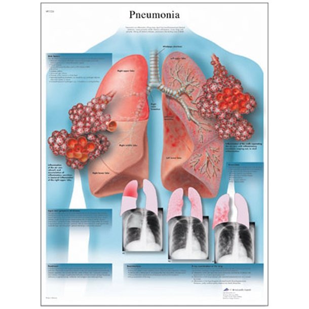 Lungebetændelse - pneumoni. Anatomisk plakat.