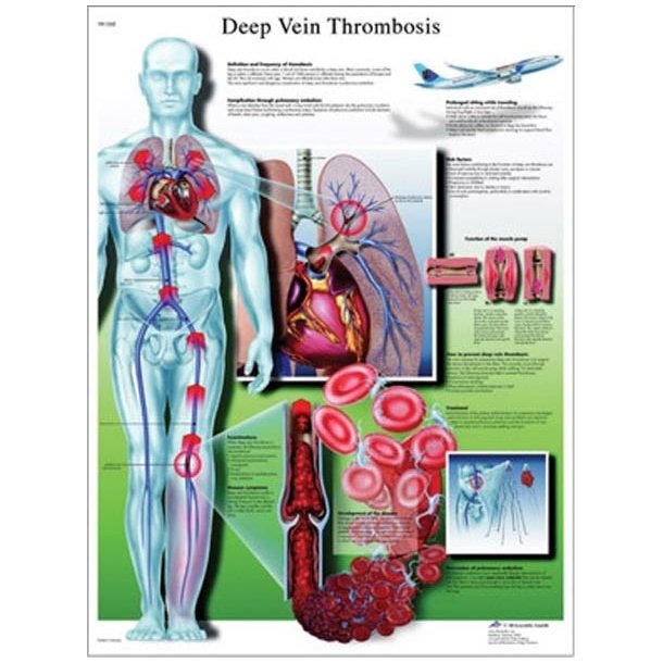 Blodprop i benet - Dyb vene thrombose. Anatomisk plakat .