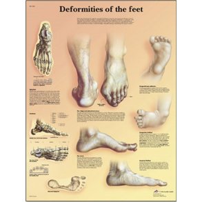 Plakat - fodens deformiteter sygdomme