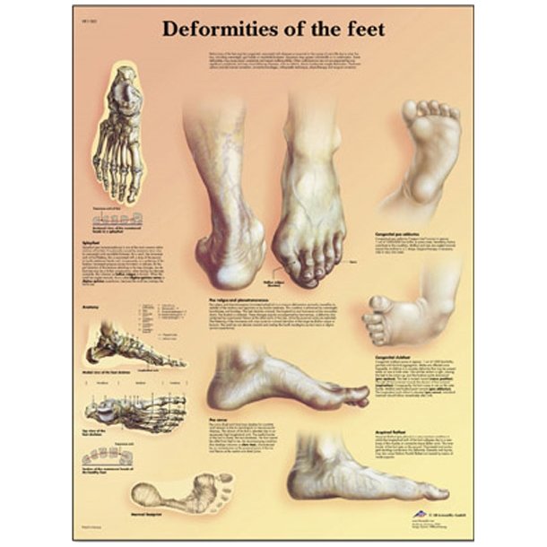 Plakat - fodens deformiteter sygdomme