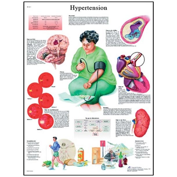 Forhjet blodtryk/hypertension. Anatomisk plakat.