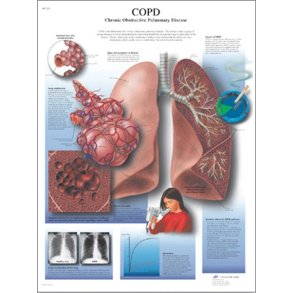 Kronisk obstruktiv lungesygdom - rygerlunger (KOL). Anatomisk plakat.