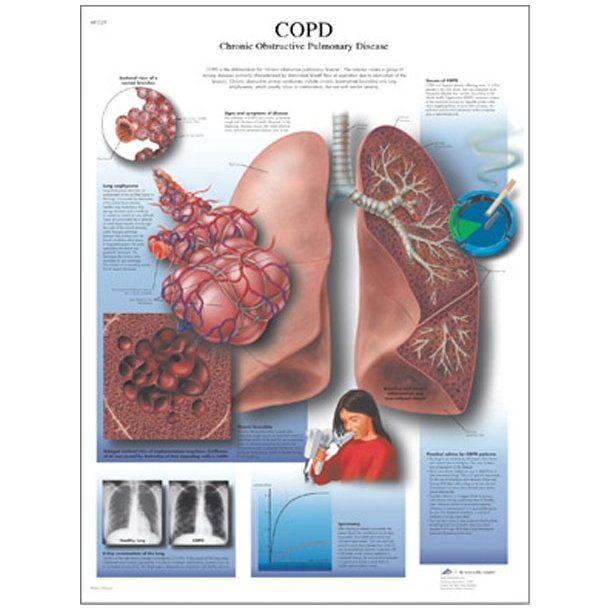 Kronisk obstruktiv lungesygdom - rygerlunger (KOL). Anatomisk plakat.