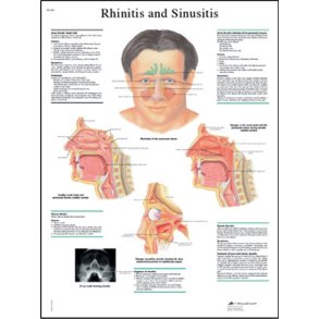 Forklelse (rhinitis) og bihulebetndelse (sinuitis). Anatomisk plakat.