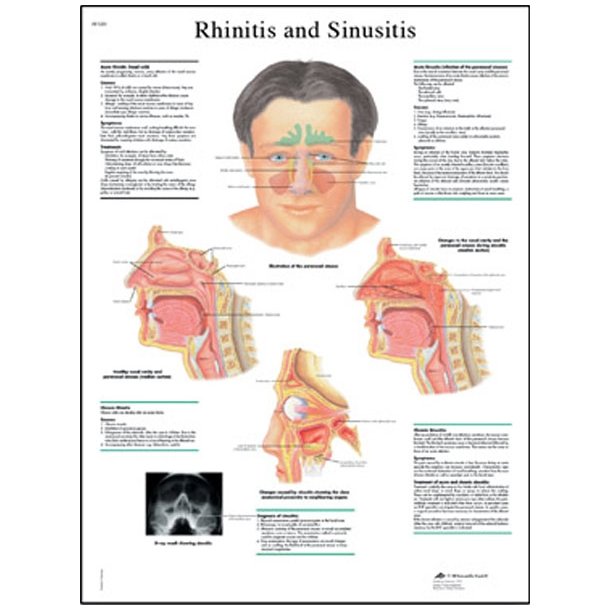 Forkølelse (rhinitis) og bihulebetændelse (sinuitis). Anatomisk plakat.