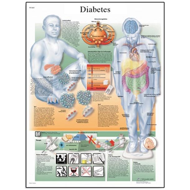 Sukkersyge/diabetes mellitus. Anatomisk plakat