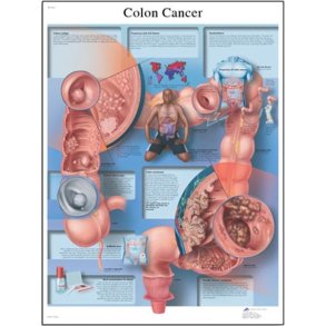 Tyktarmskrft/colon cancer. Anatomisk plakat.