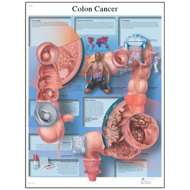 Tyktarmskrft/colon cancer. Anatomisk plakat.