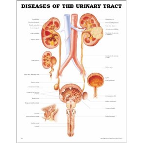 Sygdomme i urinvejene. Anatomisk plakat 50x67 cm. Lamineret med lister.