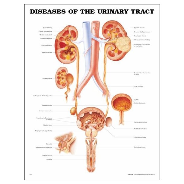 Sygdomme i urinvejene. Anatomisk plakat 50x67 cm. Lamineret med lister.
